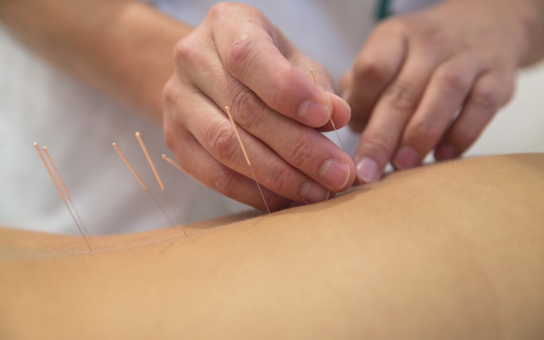 4 ways acupuncture can improve your health