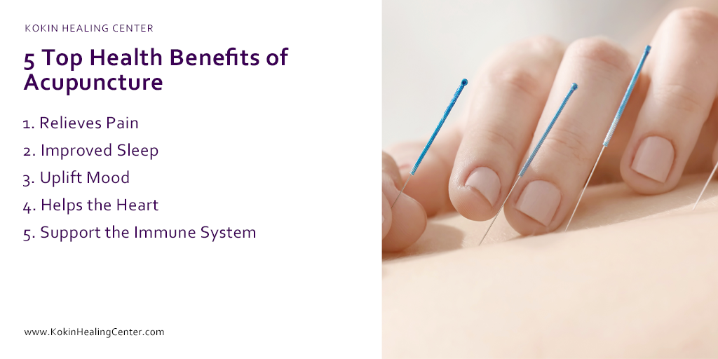 5 Top Health Benefits of Acupuncture