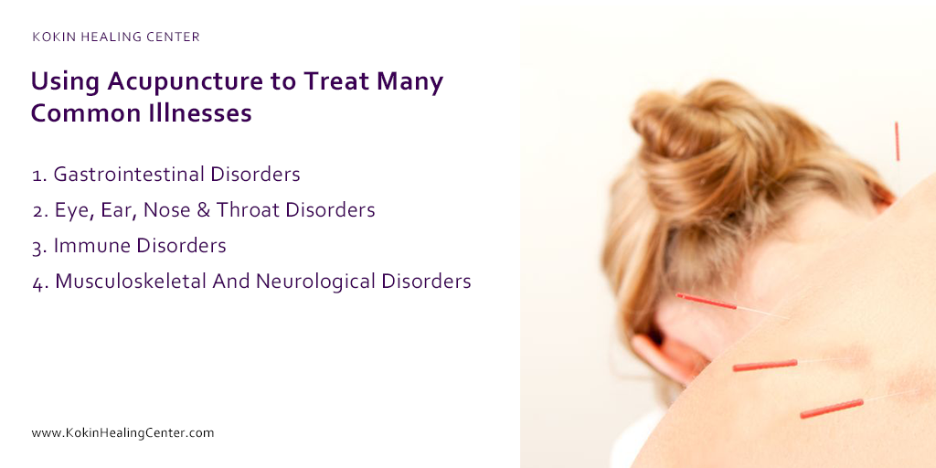 Using Acupuncture to Treat Many Common Illnesses