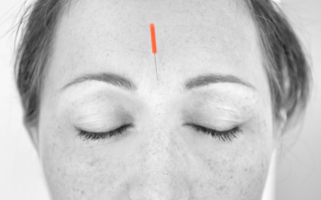 Acupuncture for Eye Health