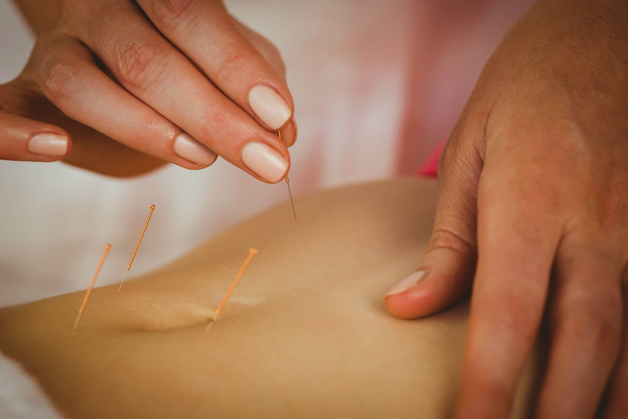 acupuncture stomach