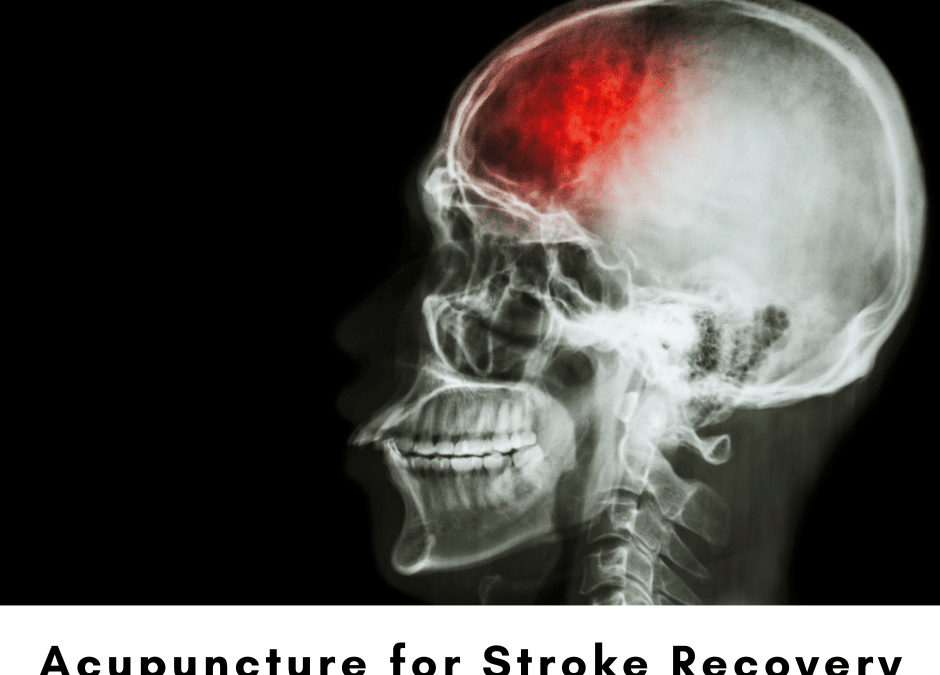 Acupuncture for Stroke Recovery
