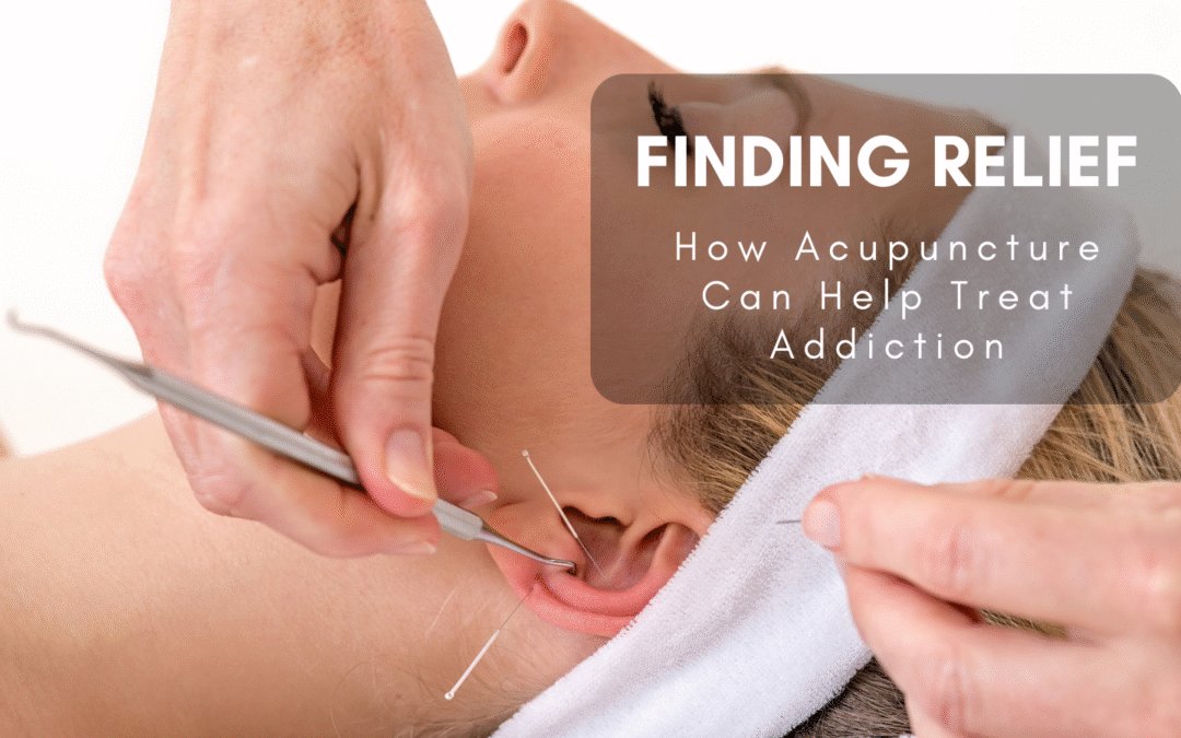 Finding Relief: How Acupuncture Can Help Treat Addiction