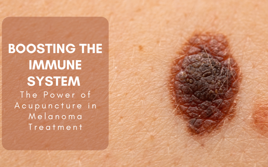 Boosting the Immune System: The Power of Acupuncture in Melanoma Treatment